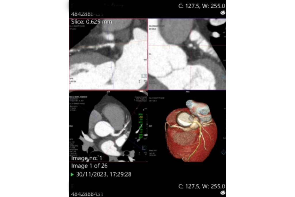 What is a CT Coronary Angiogram?