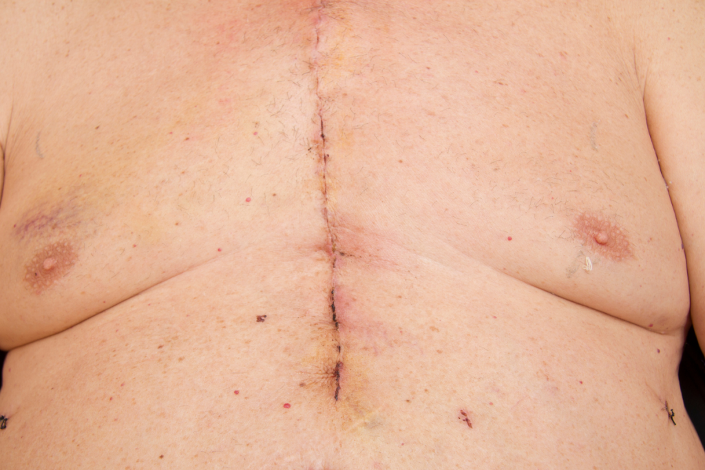 heart surgery scar