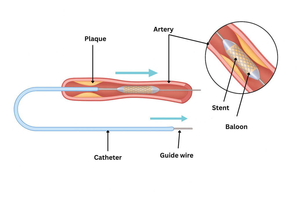 How a stent is put in simple diagram