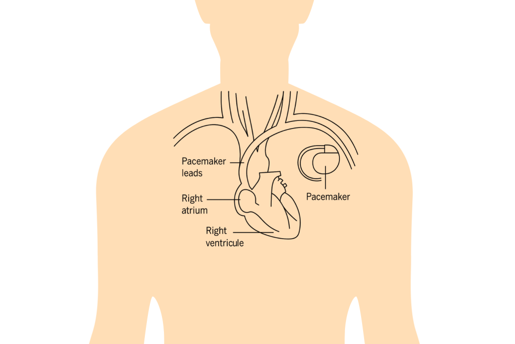 Pacemaker diagram